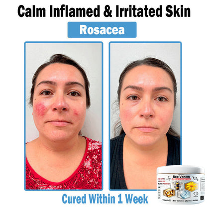 🎁Limited time extra 30% discount🎁 TOD𝑨𝑯OF® 𝑩𝒆𝐞 𝑽𝒆𝒏𝒐𝒎 𝑴𝒖𝒍𝒕𝒊-𝑺𝒚𝒎𝒑𝒕𝒐𝒎 𝑺𝒌𝒊𝒏 𝑻𝒓𝐞𝒂𝒕𝒎𝒆𝒏𝒕 𝑪𝒓𝒆𝒂𝒎