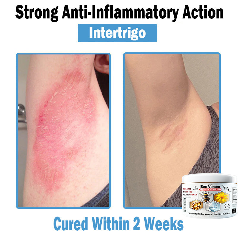 🎁Limited time extra 30% discount🎁 TOD𝑨𝑯OF® 𝑩𝒆𝐞 𝑽𝒆𝒏𝒐𝒎 𝑴𝒖𝒍𝒕𝒊-𝑺𝒚𝒎𝒑𝒕𝒐𝒎 𝑺𝒌𝒊𝒏 𝑻𝒓𝐞𝒂𝒕𝒎𝒆𝒏𝒕 𝑪𝒓𝒆𝒂𝒎