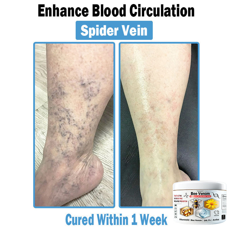 🎁Limited time extra 30% discount🎁 TOD𝑨𝑯OF® 𝑩𝒆𝐞 𝑽𝒆𝒏𝒐𝒎 𝑴𝒖𝒍𝒕𝒊-𝑺𝒚𝒎𝒑𝒕𝒐𝒎 𝑺𝒌𝒊𝒏 𝑻𝒓𝐞𝒂𝒕𝒎𝒆𝒏𝒕 𝑪𝒓𝒆𝒂𝒎