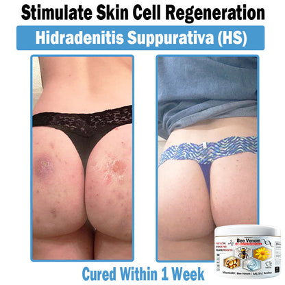 🎁Limited time extra 30% discount🎁 TOD𝑨𝑯OF® 𝑩𝒆𝐞 𝑽𝒆𝒏𝒐𝒎 𝑴𝒖𝒍𝒕𝒊-𝑺𝒚𝒎𝒑𝒕𝒐𝒎 𝑺𝒌𝒊𝒏 𝑻𝒓𝐞𝒂𝒕𝒎𝒆𝒏𝒕 𝑪𝒓𝒆𝒂𝒎