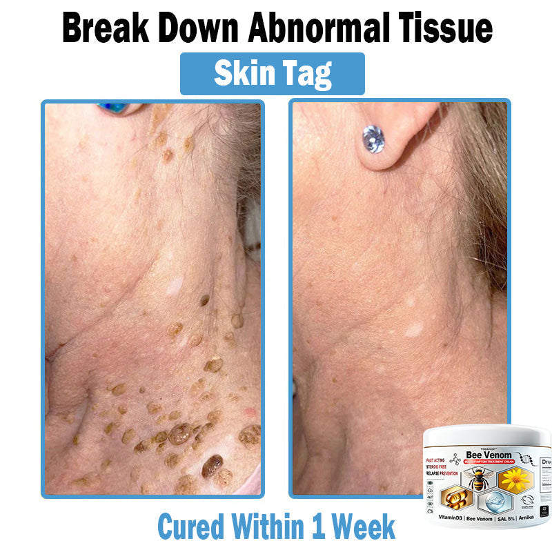 🎁Limited time extra 30% discount🎁 TOD𝑨𝑯OF® 𝑩𝒆𝐞 𝑽𝒆𝒏𝒐𝒎 𝑴𝒖𝒍𝒕𝒊-𝑺𝒚𝒎𝒑𝒕𝒐𝒎 𝑺𝒌𝒊𝒏 𝑻𝒓𝐞𝒂𝒕𝒎𝒆𝒏𝒕 𝑪𝒓𝒆𝒂𝒎