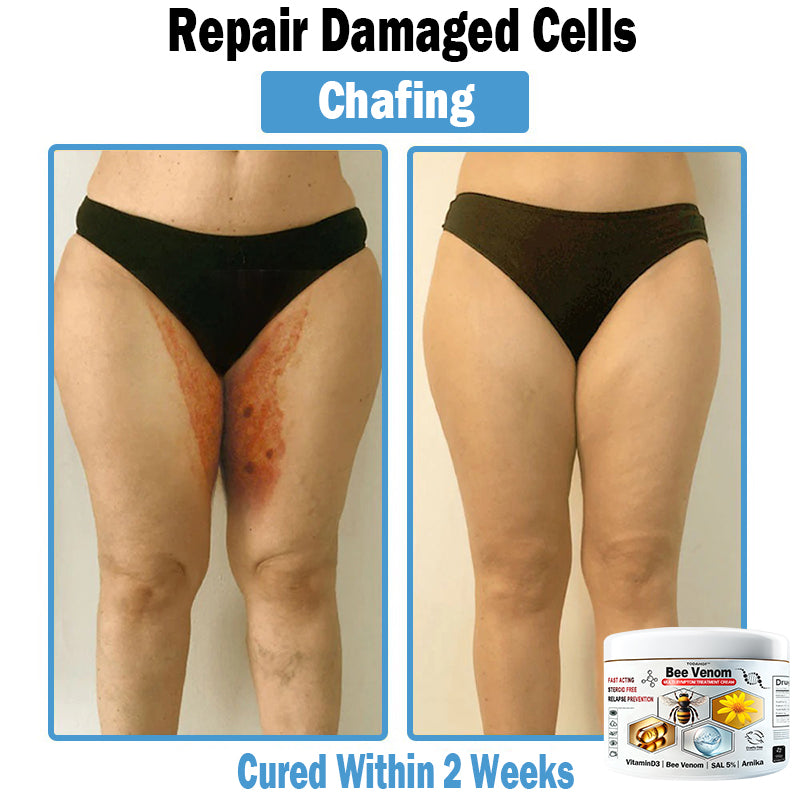 🎁Limited time extra 30% discount🎁 TOD𝑨𝑯OF® 𝑩𝒆𝐞 𝑽𝒆𝒏𝒐𝒎 𝑴𝒖𝒍𝒕𝒊-𝑺𝒚𝒎𝒑𝒕𝒐𝒎 𝑺𝒌𝒊𝒏 𝑻𝒓𝐞𝒂𝒕𝒎𝒆𝒏𝒕 𝑪𝒓𝒆𝒂𝒎