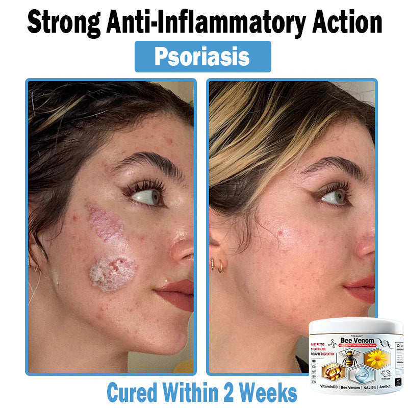 🎁Limited time extra 30% discount🎁 TOD𝑨𝑯OF® 𝑩𝒆𝐞 𝑽𝒆𝒏𝒐𝒎 𝑴𝒖𝒍𝒕𝒊-𝑺𝒚𝒎𝒑𝒕𝒐𝒎 𝑺𝒌𝒊𝒏 𝑻𝒓𝐞𝒂𝒕𝒎𝒆𝒏𝒕 𝑪𝒓𝒆𝒂𝒎