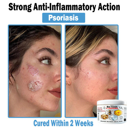 🎁Limited time extra 30% discount🎁 TOD𝑨𝑯OF® 𝑩𝒆𝐞 𝑽𝒆𝒏𝒐𝒎 𝑴𝒖𝒍𝒕𝒊-𝑺𝒚𝒎𝒑𝒕𝒐𝒎 𝑺𝒌𝒊𝒏 𝑻𝒓𝐞𝒂𝒕𝒎𝒆𝒏𝒕 𝑪𝒓𝒆𝒂𝒎